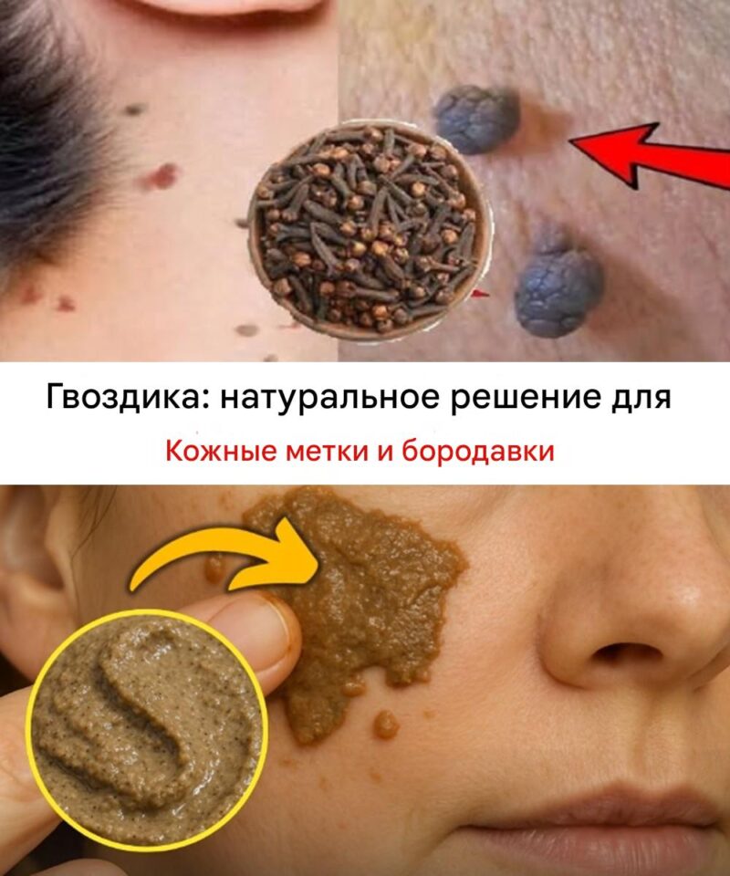 Как свести бородавки и папилломы народными средствами 